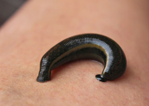 Eine Person, die eine Blutegeltherapie erhält, eine naturheilkundliche Behandlung zur Förderung der Entgiftung